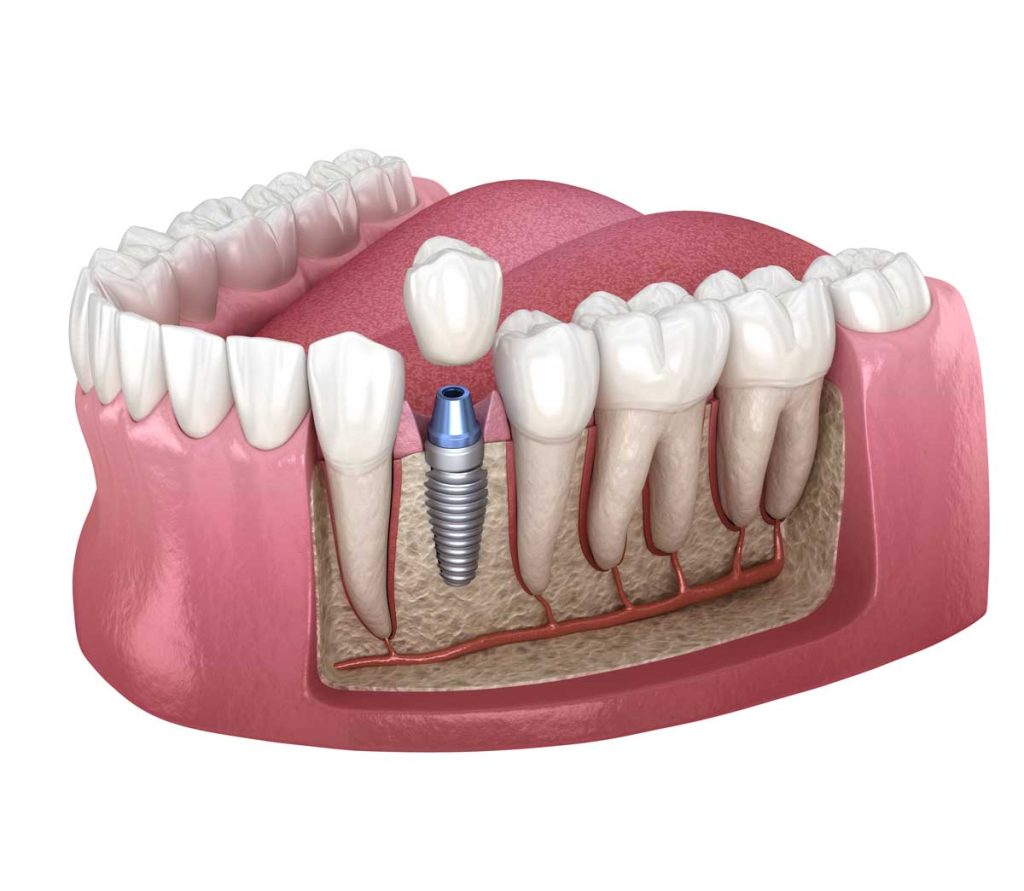 3d dental illustration of dental implant showing expose root structure of surrounding teeth