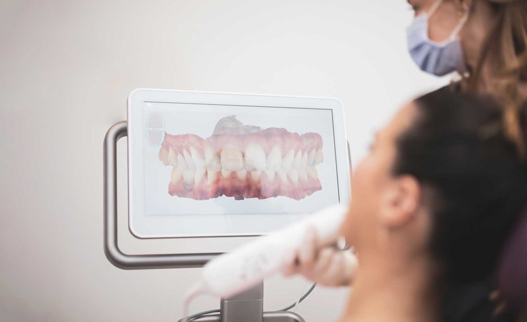 Intraoral 3D Scanner